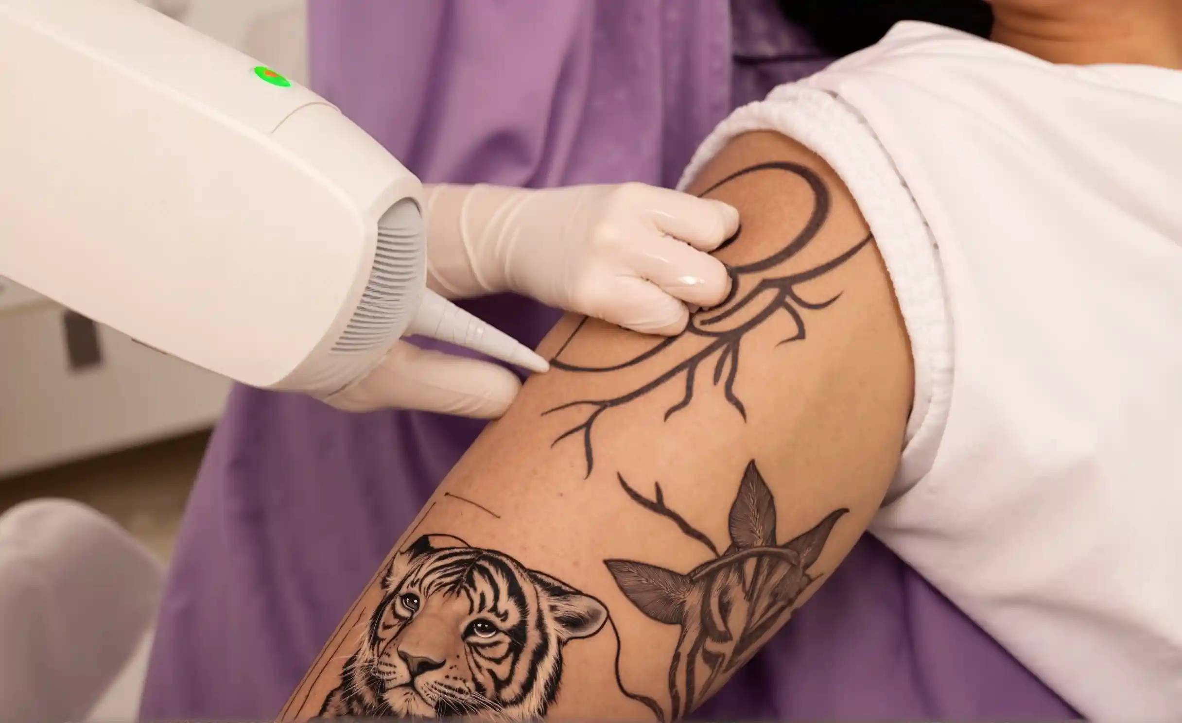 Professional consultation with a tattoo removal specialist