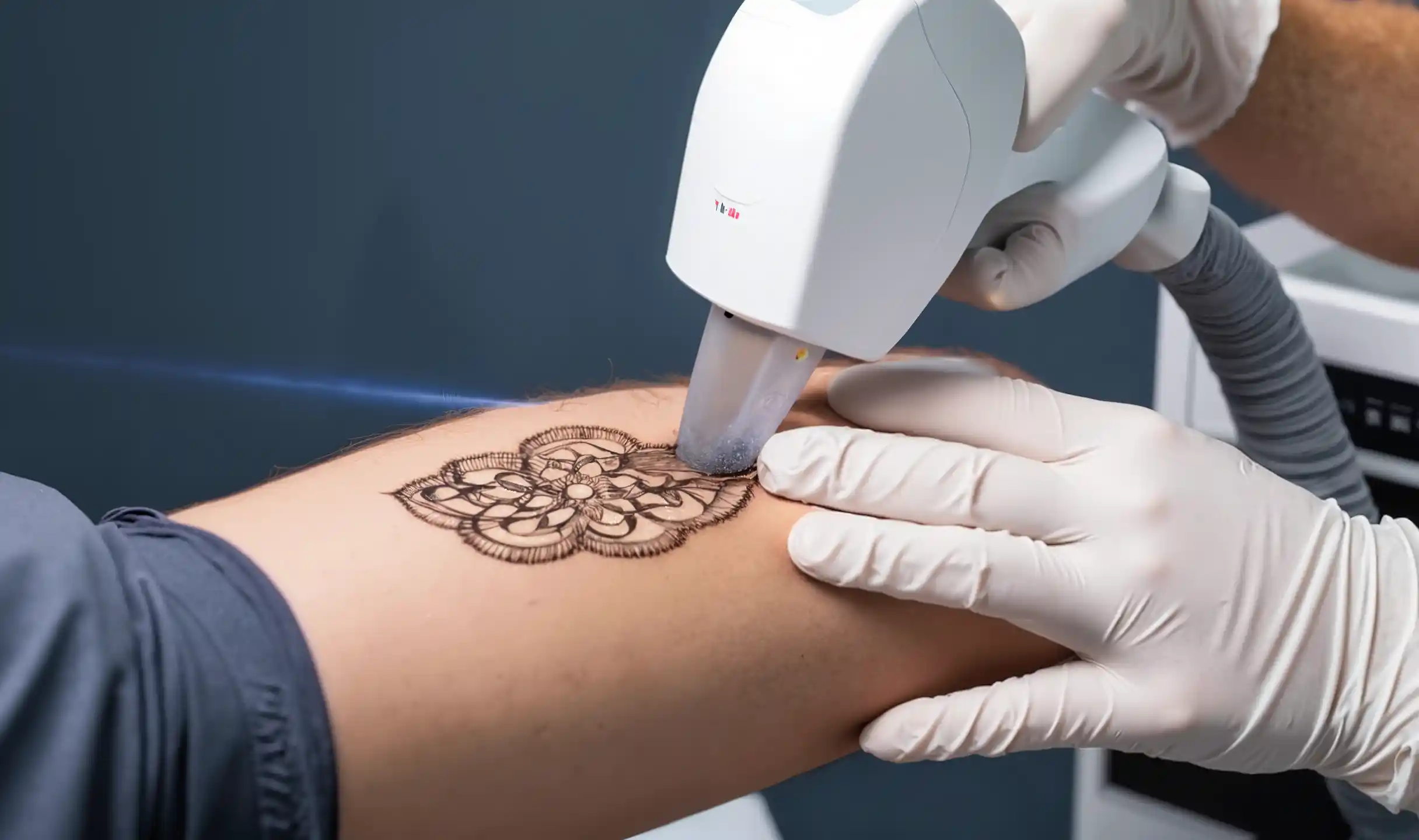 Detailed illustration of laser tattoo removal process