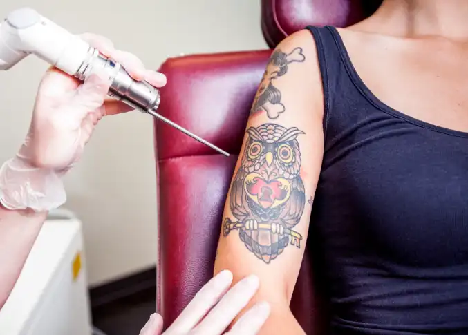 Professional laser tattoo removal treatment being performed