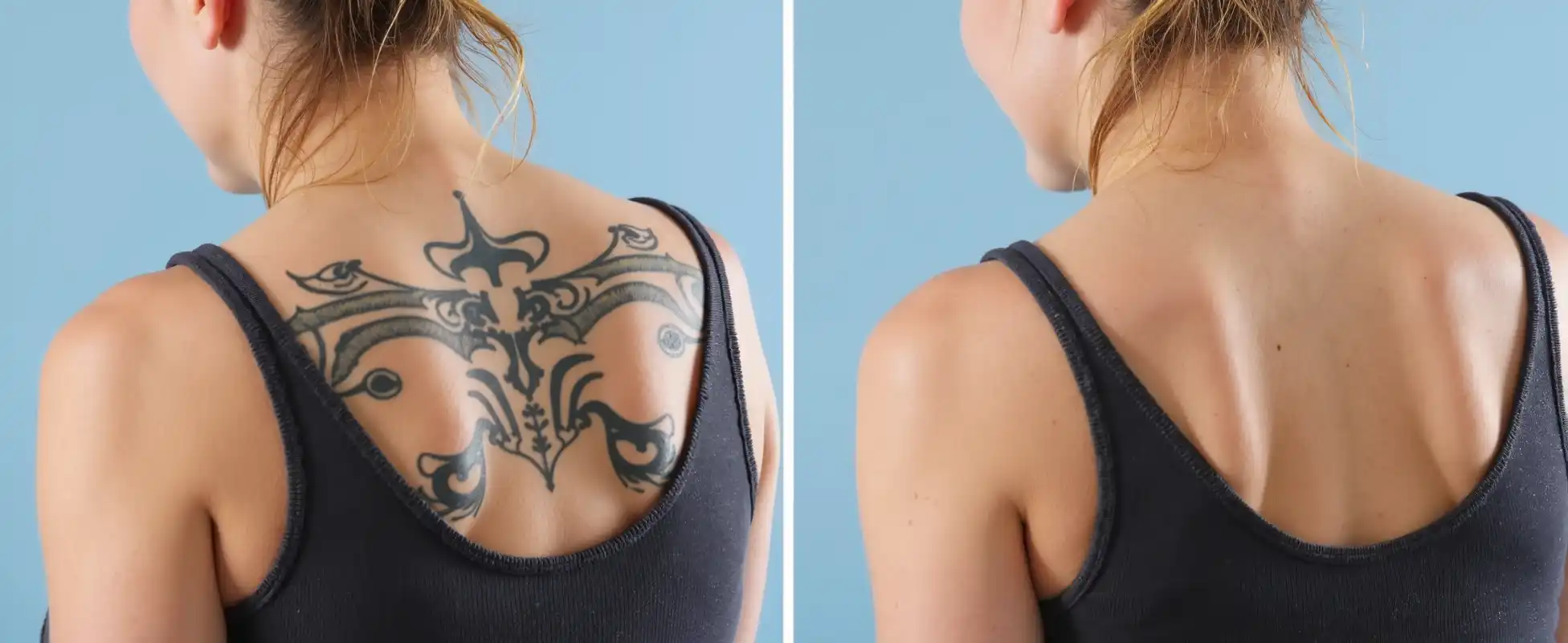 Before and after results of tattoo removal