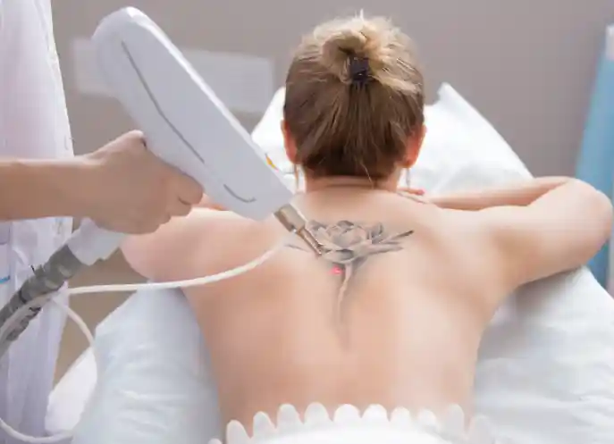 Professional cosmetic tattoo removal procedure