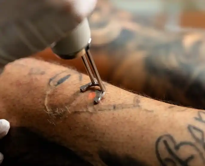 Close-up of laser tattoo removal procedure